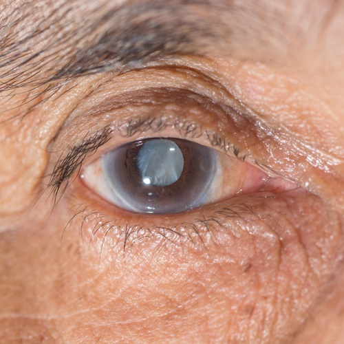 Bissell Eye Care, Cataract