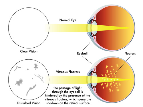 Bissell Eye Care, Eye Floaters, eye Spots