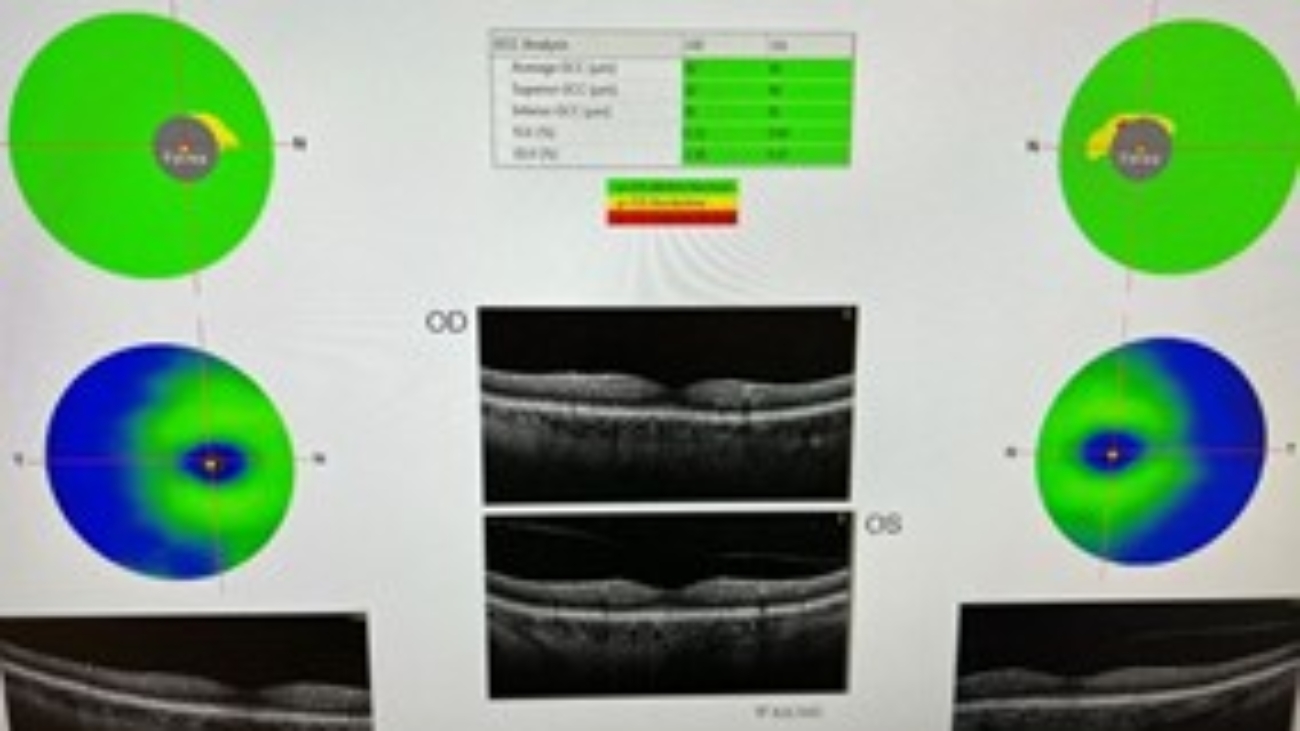 Comprehensive Eye Assessment of Ocular Health