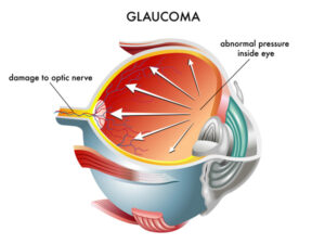 Glaucoma Illustration