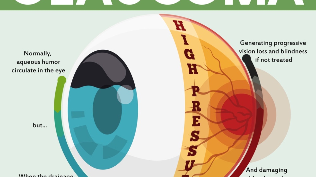 Infographic-poster-with-detailed-effects-of-untreated-glaucoma-disease-showing-the-passing-through-a-good-and-healthy-eye-to-a-rogressive-vision loss