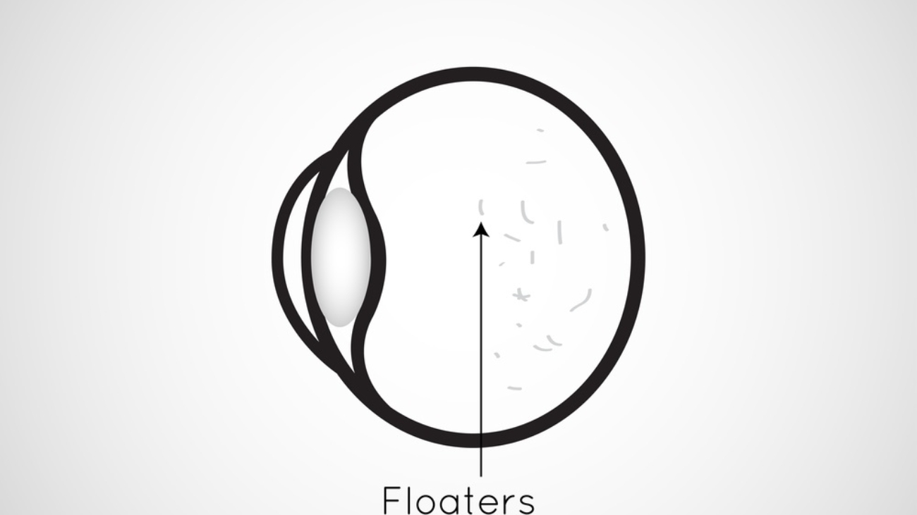 An outline diagram of an eye viewed sideways with Eye Floaters printed above it.