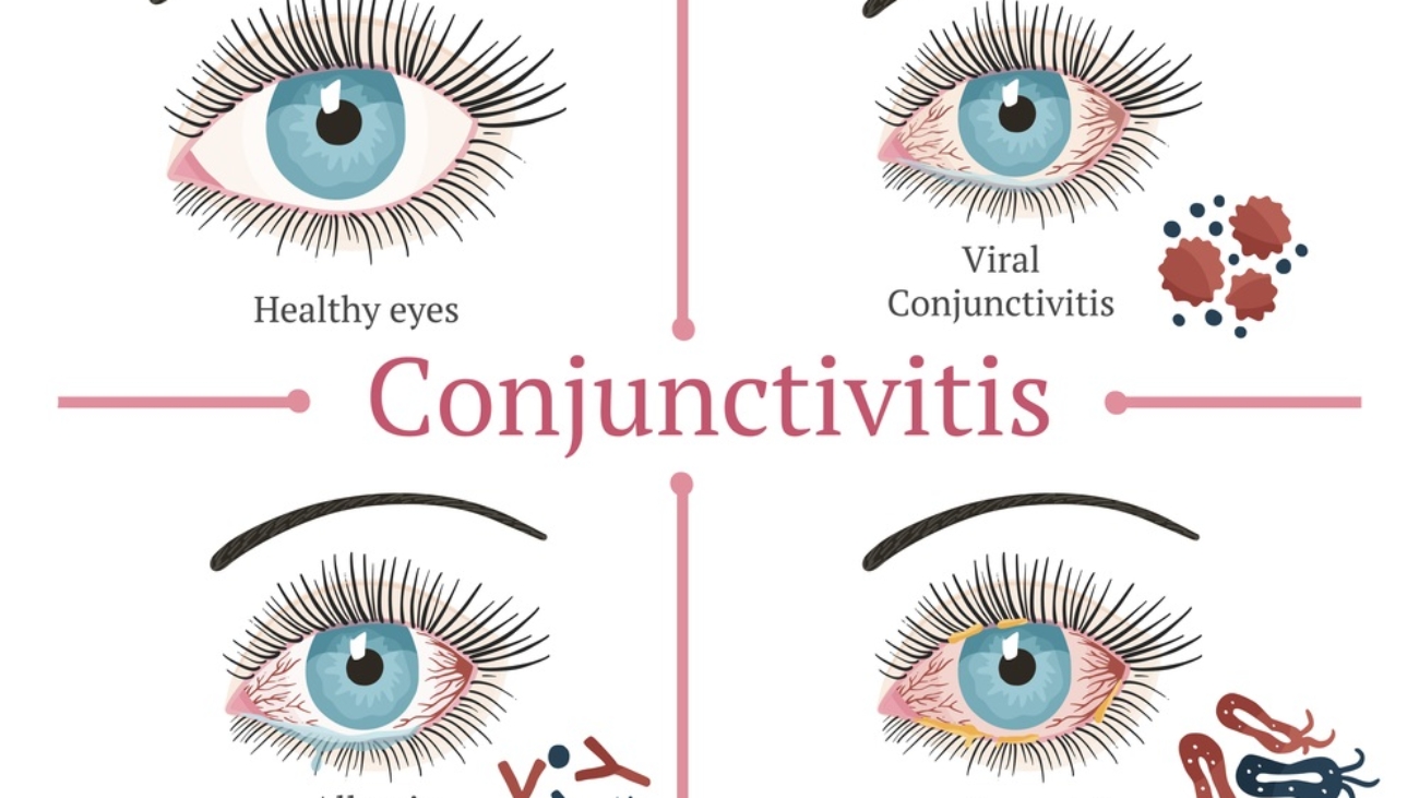 A-Square-outline-divided-in-4-quadrants-showing-an-illustration-with-4-eyeballs-with-different-types-of-conjunctivitis.