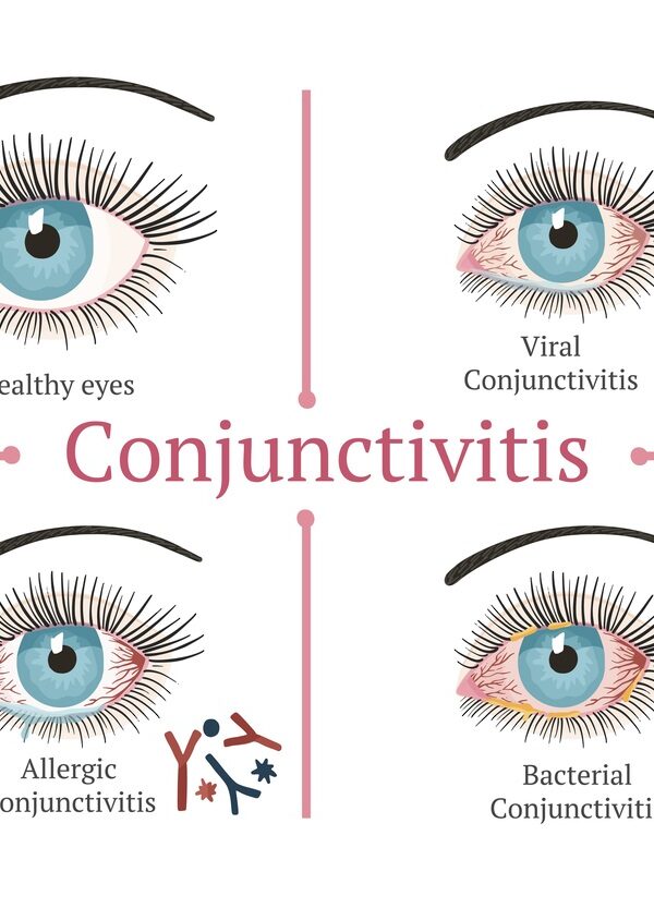 A-Square-outline-divided-in-4-quadrants-showing-an-illustration-with-4-eyeballs-with-different-types-of-conjunctivitis.
