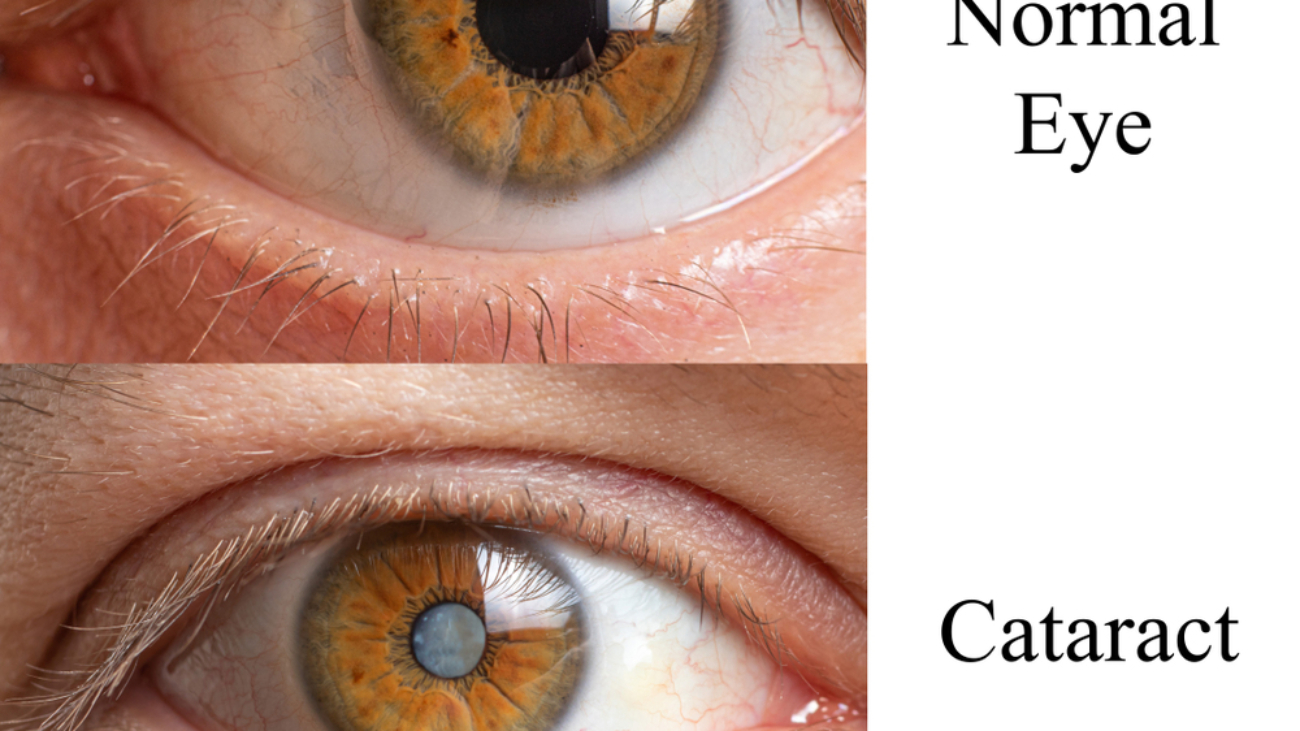 Comparison of a healthy human eye and an eye with a clouded lens cataract - to prevent cataracts