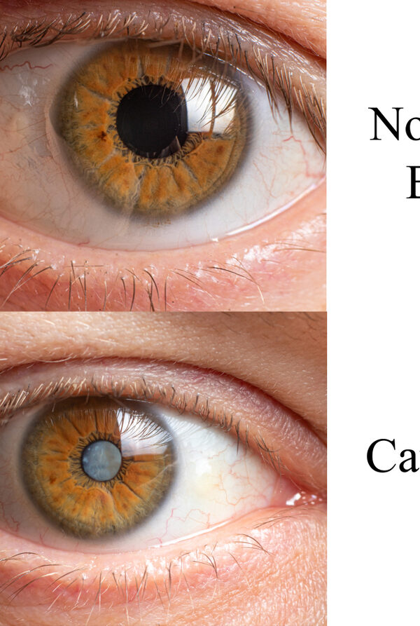 Comparison of a healthy human eye and an eye with a clouded lens cataract - to prevent cataracts