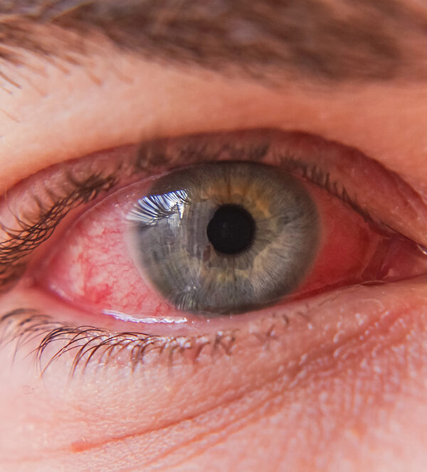severe flu season and pink eye - close up of irritated eye with pink eye