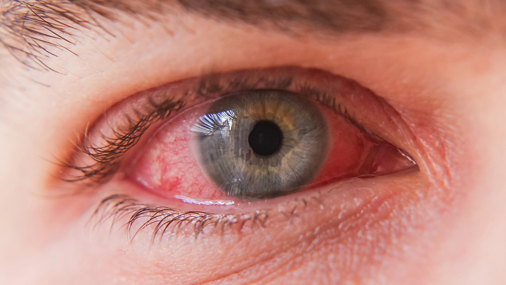 severe-flu-season-and-pink-eye