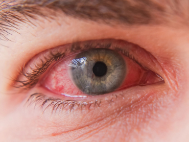 severe-flu-season-and-pink-eye