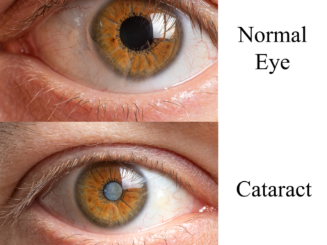 Comparison of a healthy human eye and an eye with a clouded lens cataract.